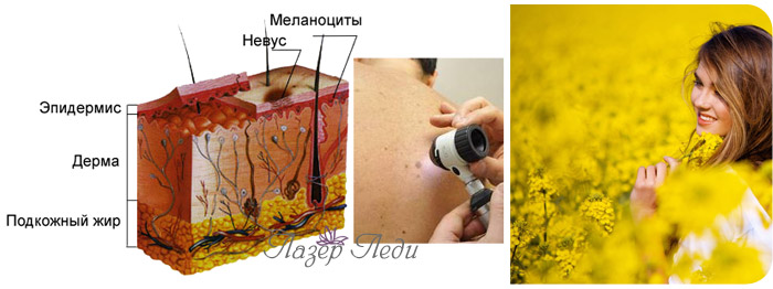 Профилактика и меры предосторожности, предотвращающие развитие меланомы Профилактика и меры предосторожности, предотвращающие развитие меланомы, невус, выбор метода и эффективности лечения, ЛазерЛеди